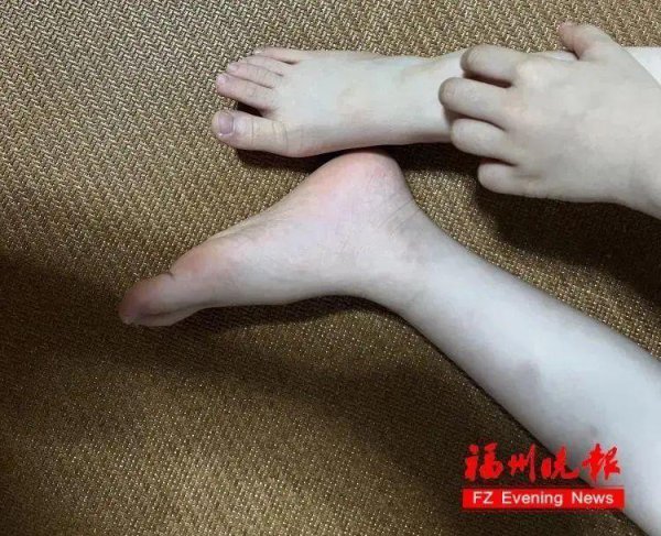 一醒悟来身上密密匝匝全是! 天热高发, 家家户户王人在用! 